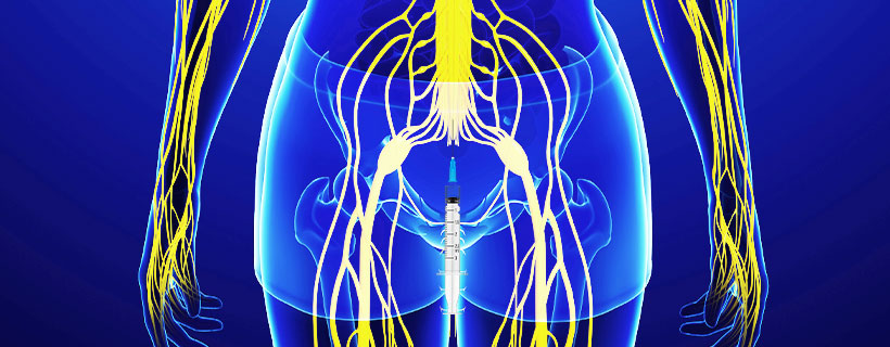 patient receiving Caudal Epidural Steroid Injections in Garland for auto accident injury pain relief