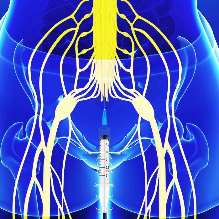 caudal epidural steroid injections in Garland