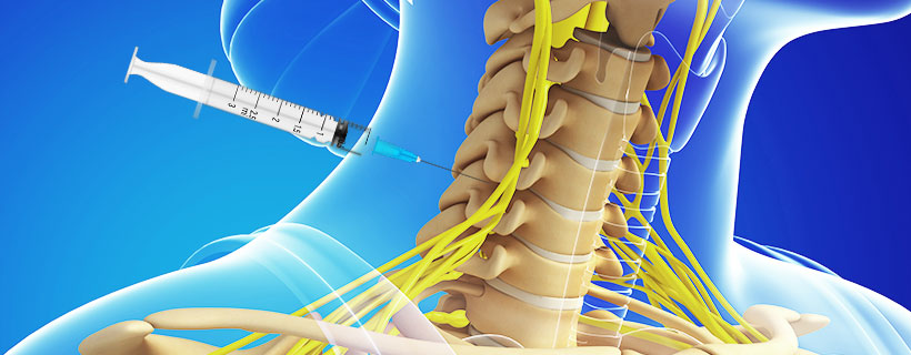 patient receiving Cervical Epidural Steroid Injections in Garland for auto accident injury pain relief