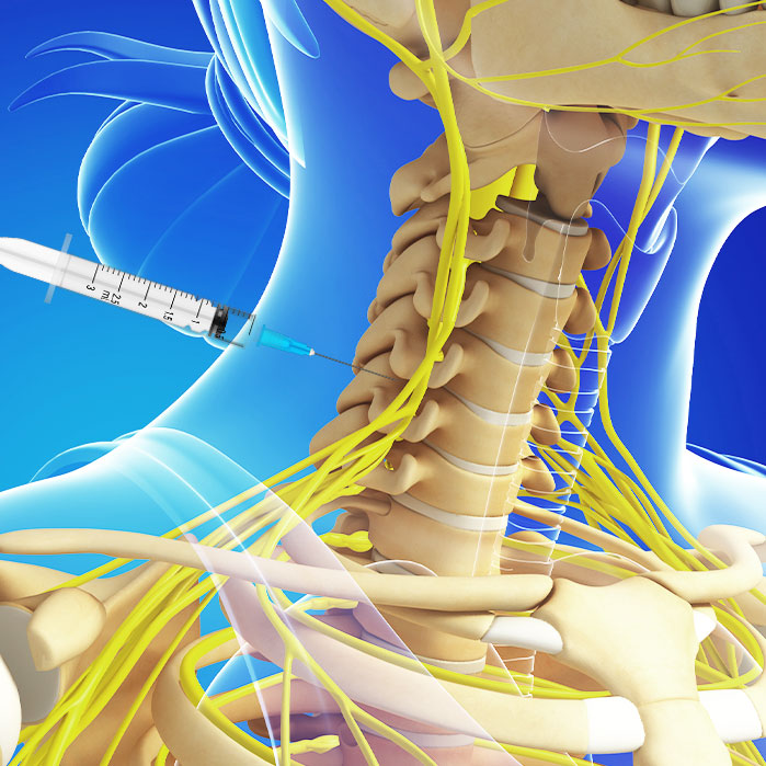 cervical epidural steroid injections in Garland