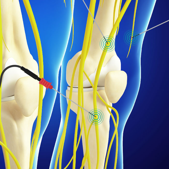 genicular nerve ablation in Garland