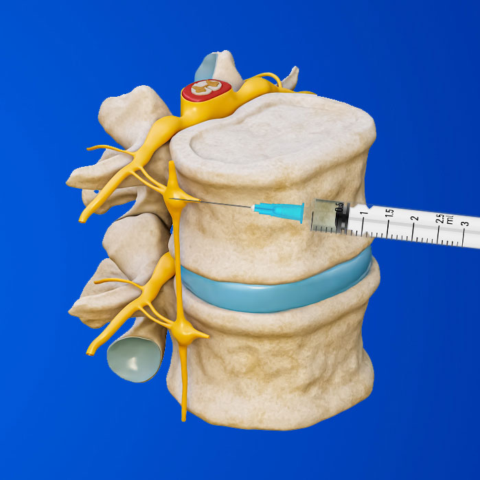 lumbar sympathetic block in Garland