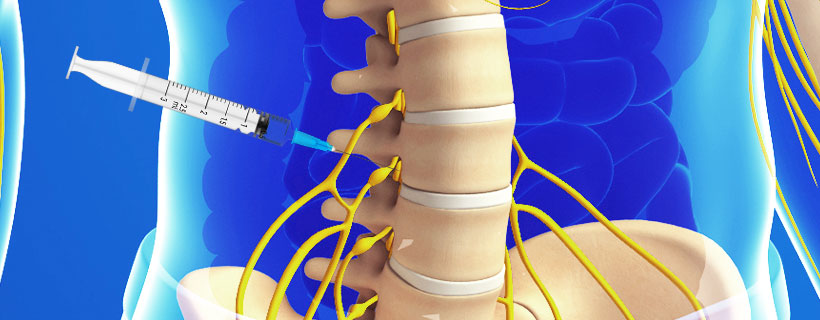 patient receiving Lumbar Transforaminal Epidural Steroid Injections in Garland for auto accident injury pain relief