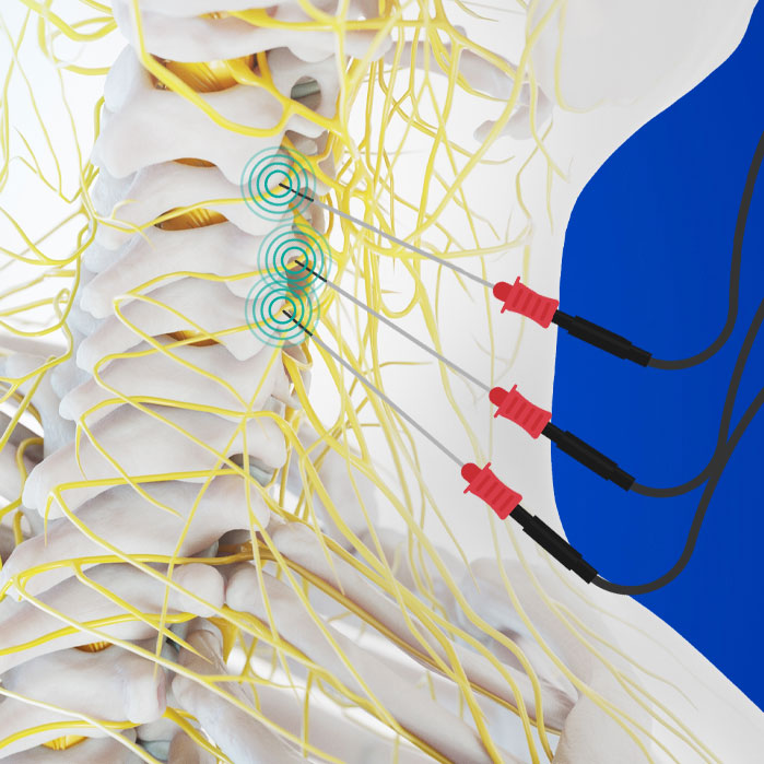 radiofrequency neurotomy in Garland