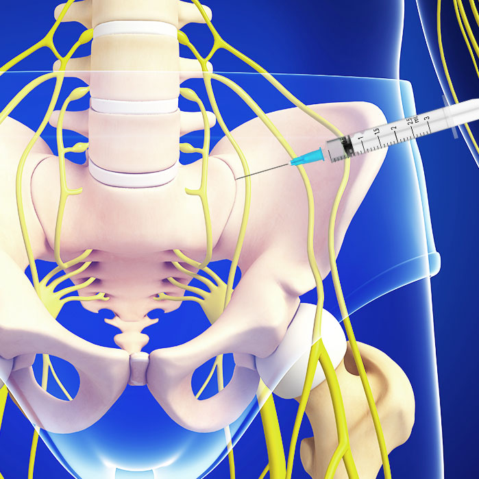 sacroiliac joint steroid injections in Garland