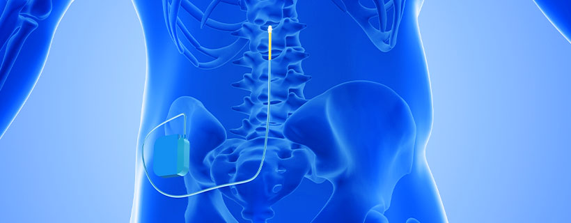 patient receiving Spinal Cord Stimulator Implant in Garland for auto accident injury pain relief