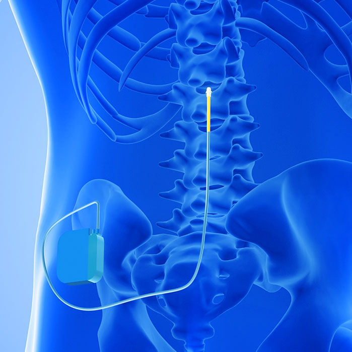 spinal cord stimulator implant in Garland