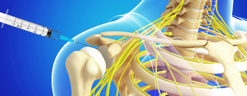 patient receiving Subacromial Injections in Garland for auto accident injury pain relief