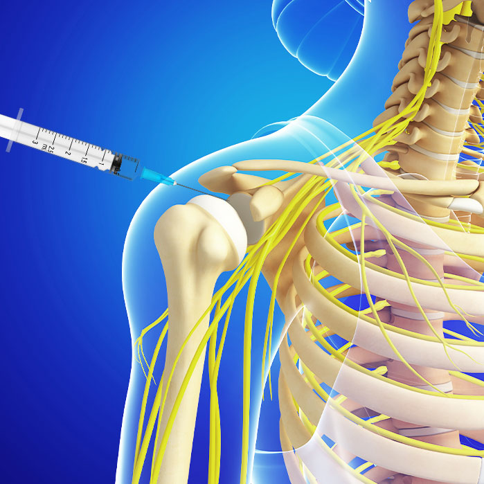 subacromial injections in Garland