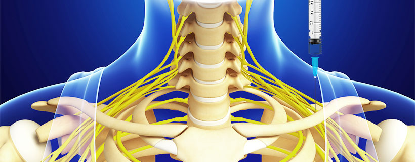 patient receiving Suprascapular Nerve Block in Garland for auto accident injury pain relief