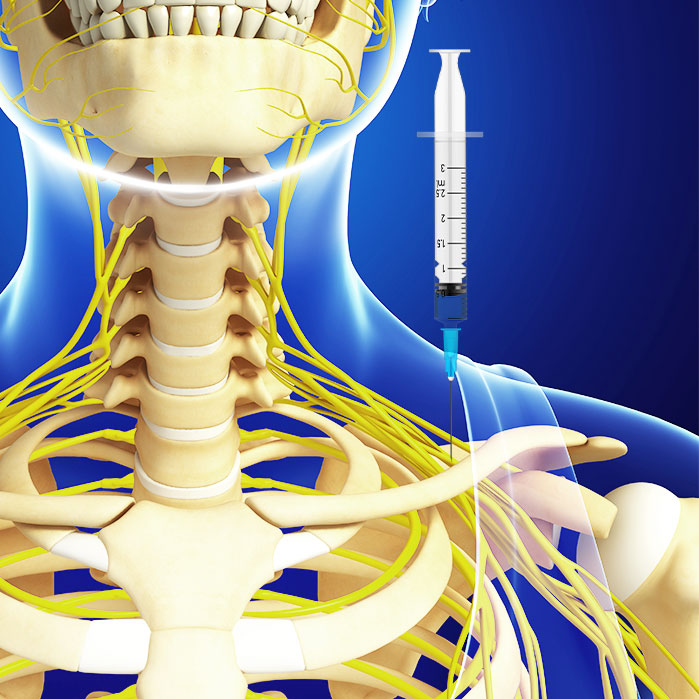 suprascapular nerve block in Garland