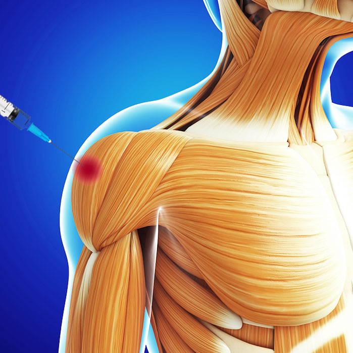 trigger point injections in Garland