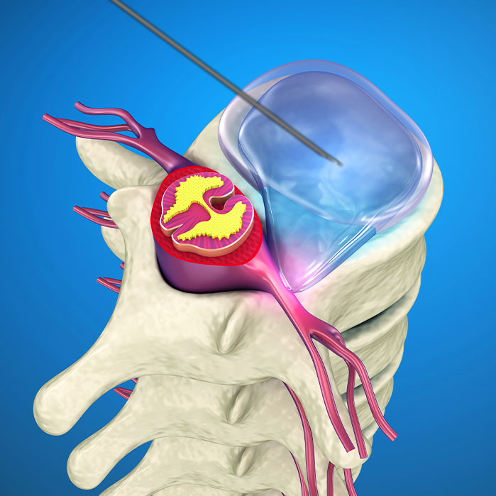 yess endoscopic discectomy in Garland